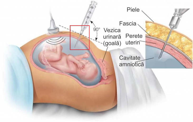amniocenteza